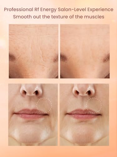 Radio Frequency Skin Tightening Device with 3 Levels L7176